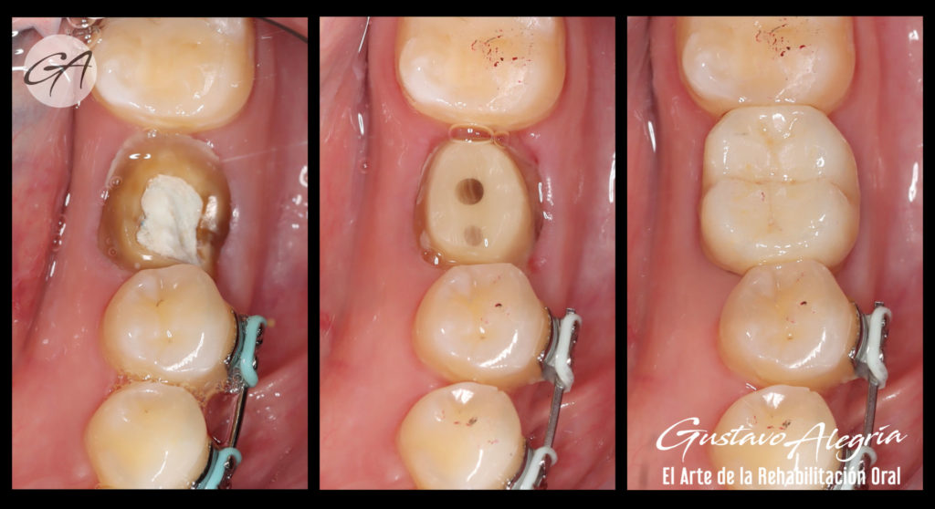 CORONA-LIBRE-DE-METAL