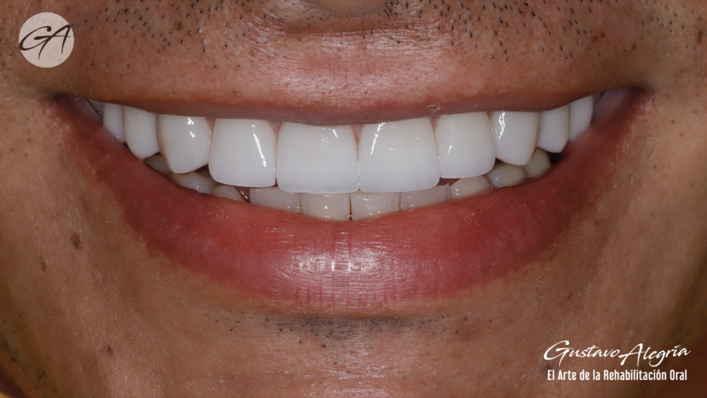 LENTES CERAMICOS (VENEERS)