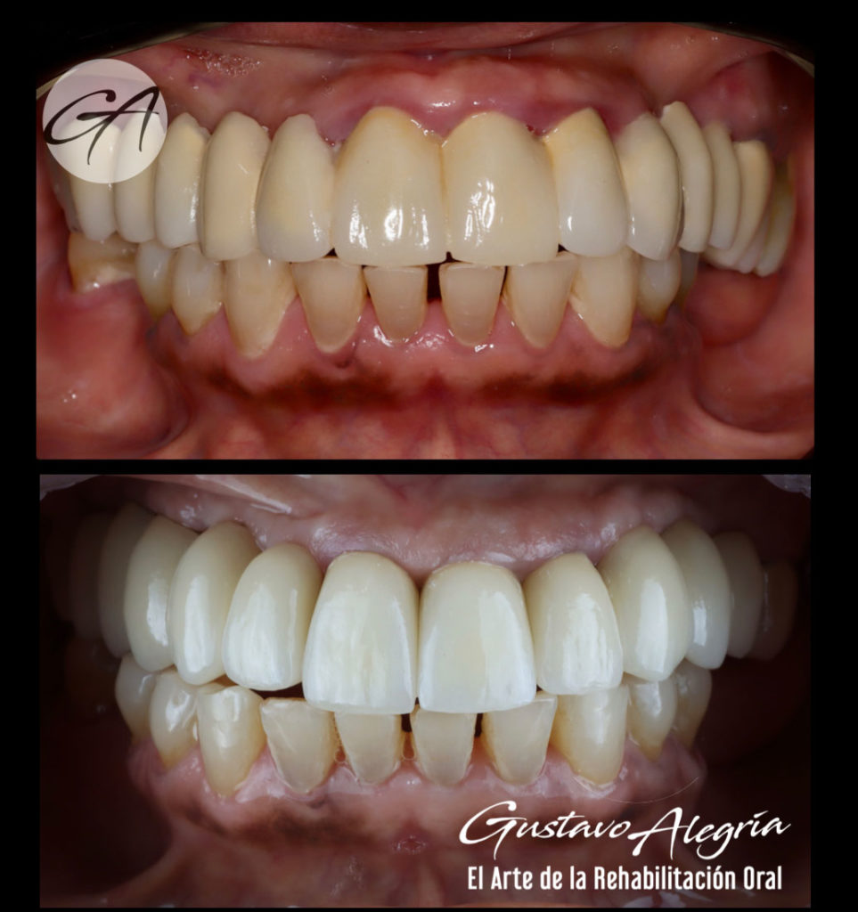 CAMBIO-DE-PROTESIS-FIJA-A-CORONAS-SOBRE-IMPLANTES-Y-SOBRE-DIENTES