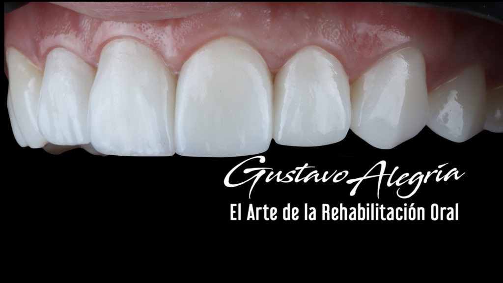 LENTES CERAMICOS (VENEERS)