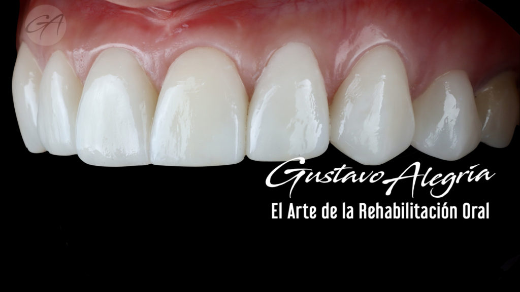 LENTES CERAMICOS (VENEERS)