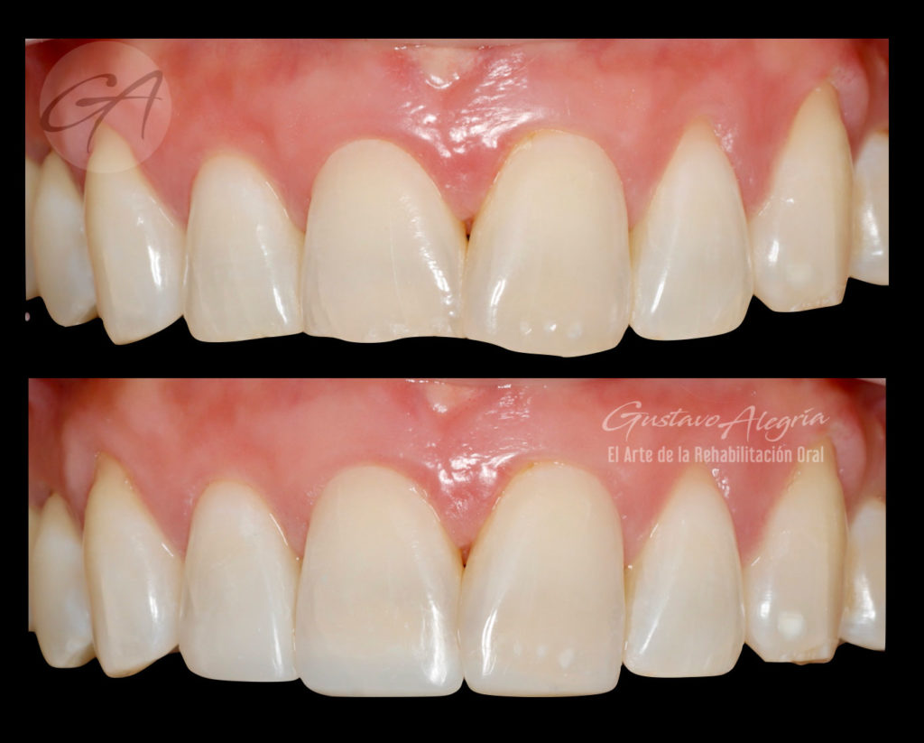 RECONSTRUCCION-DE-BORDES-EN-RESINA-(COMPOSITE)