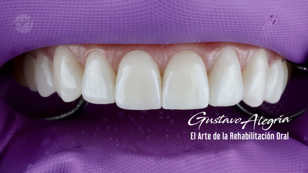 LENTES CERAMICOS (VENEERS)
